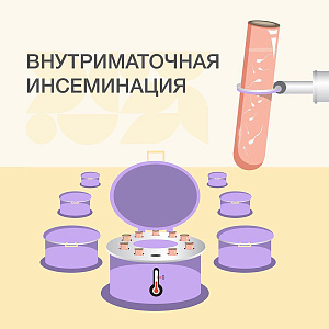 Внутриматочная инсеминация